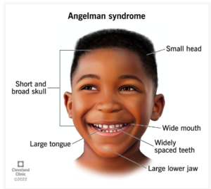 Angelman syndrome may cause some distinct facial characteristics in addition to neurological symptoms.